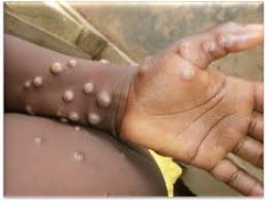 WHO lists additional mpox diagnostic tests for emergency use